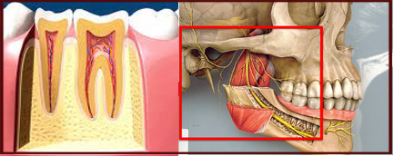 عصب کشی کلینیک دندانپزشکی آرمان