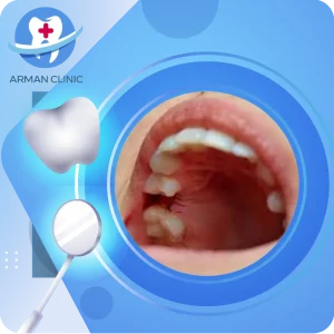 علت باز شدن بخیه ایمپلنت