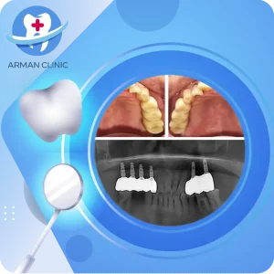 ایمپلنت دندان در کرج - عکس رادیوگرافی پایه ایمپلنت