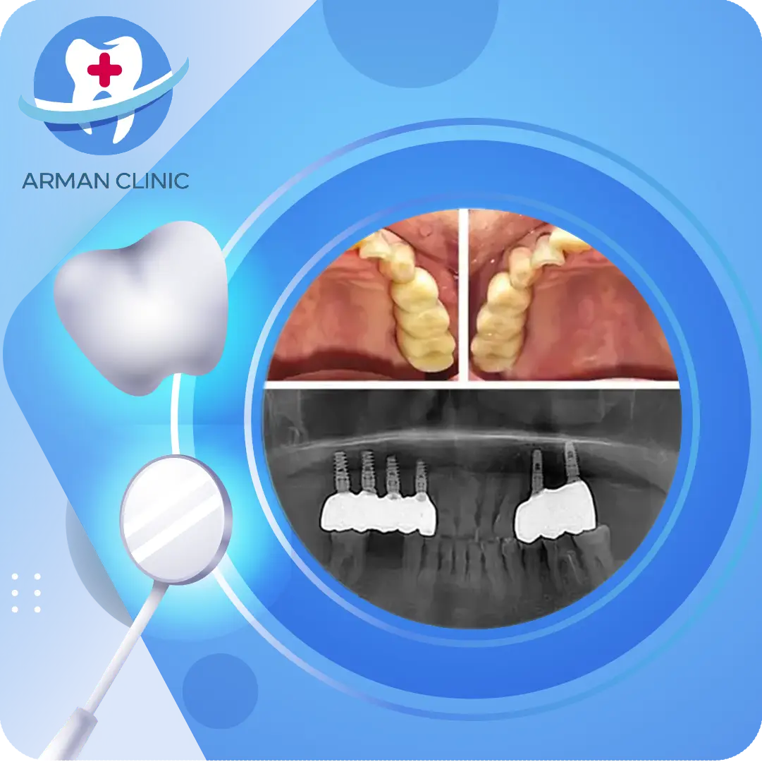 ایمپلنت دندان در کرج - عکس رادیوگرافی پایه ایمپلنت