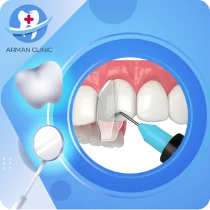 انواع کامپوزیت دندان