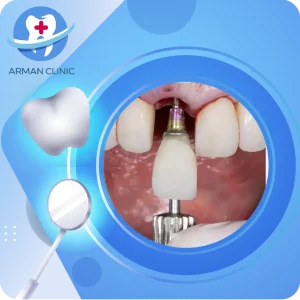 ایمپلنت دندان جلو
