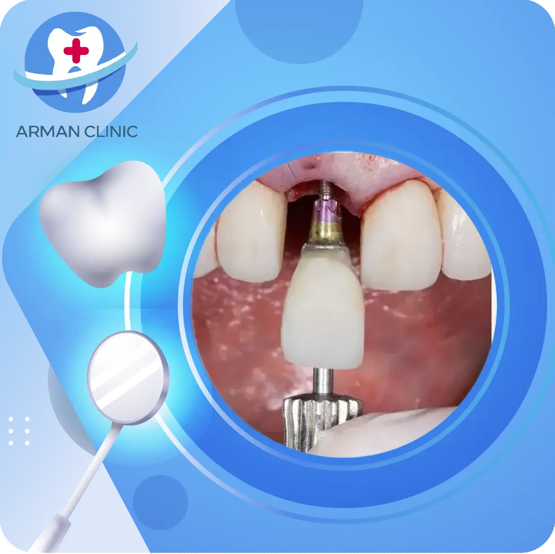 ایمپلنت دندان جلو