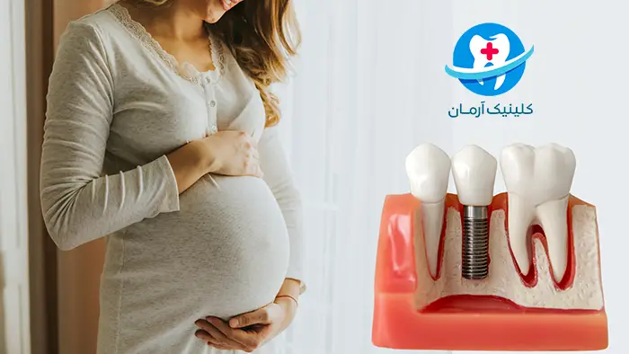 ایمپلنت در دوران بارداری