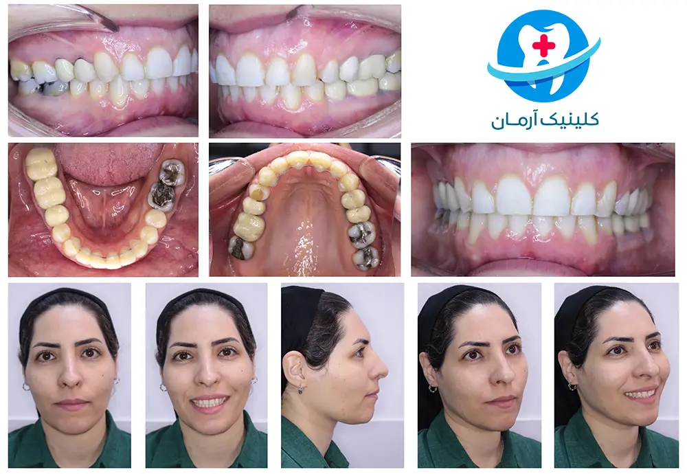 نمونه کار ارتودنسی روی بیمار - متخصص ارتودنسی در فردیس - بهترین متخصص ارتودنسی 1405 -