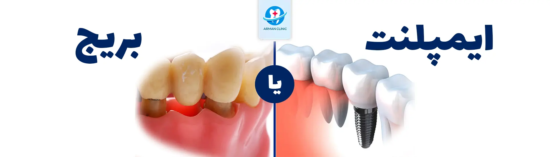 arman bridge implant