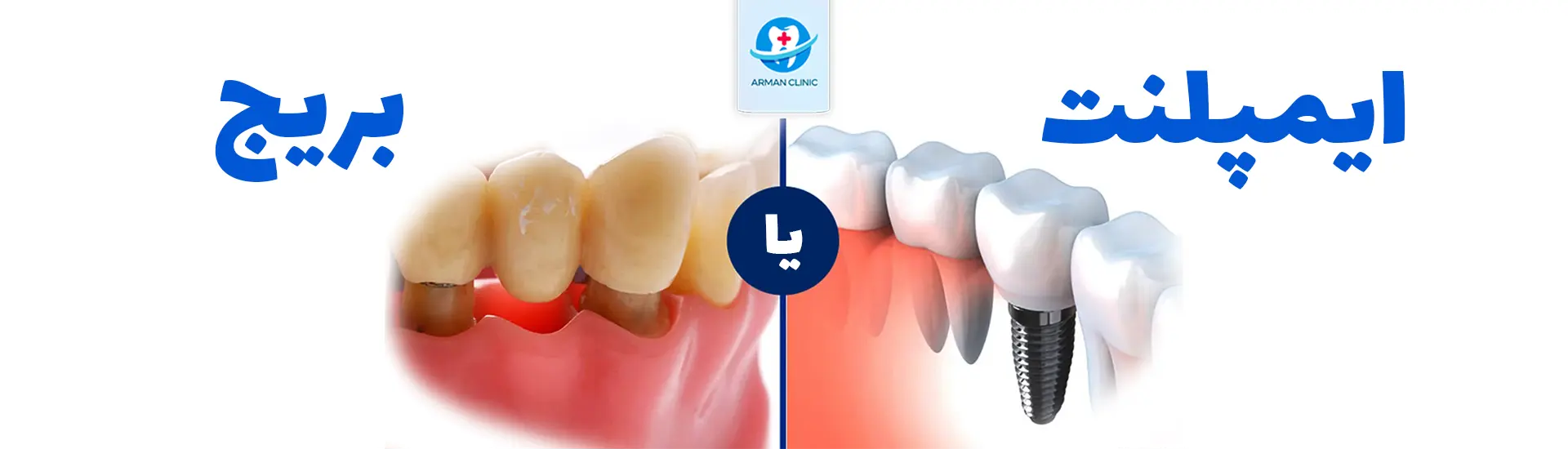 arman bridge or implant