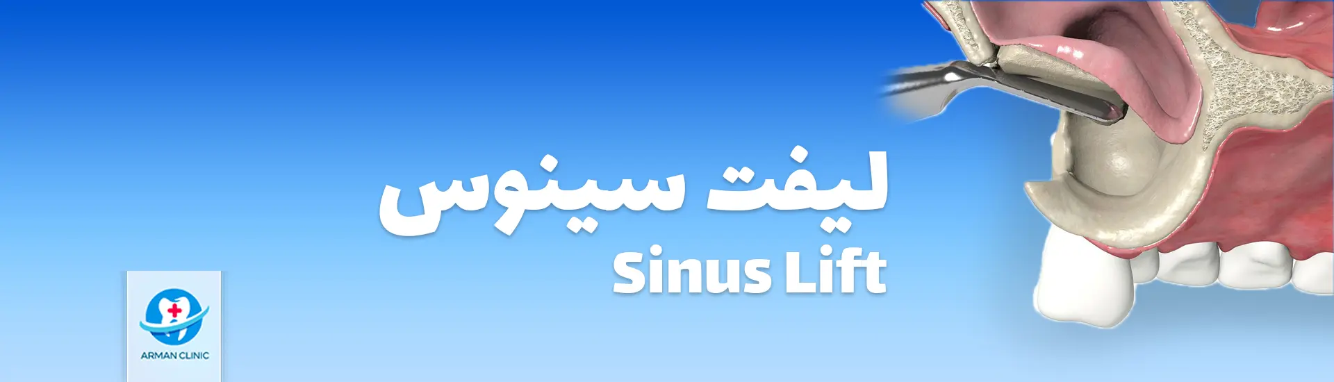 sinus lift