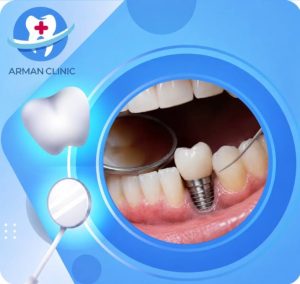 انتخاب آگاهانه برای جایگزینی دندان‌های از دست‌رفته | متخصص ایمپلنت در کرج