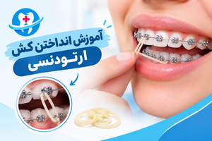 کش ارتودنسی